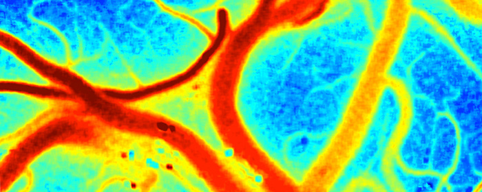 infrared scan of brain undergoing nanosurgery